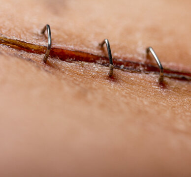 Staples surgical incision healing scar transplant operation closeup