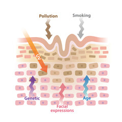 Cause of wrinkles on skin layer vector illustration isolated on white background. Age, ultraviolet radiation, smoking, pollution, facial expressions, genetic causes lines and creases to form on skin.
