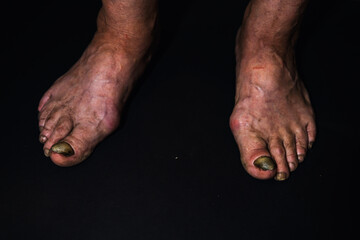 A close-up toenail suffering from onycholysis, characterized by its separation from the nail bed.