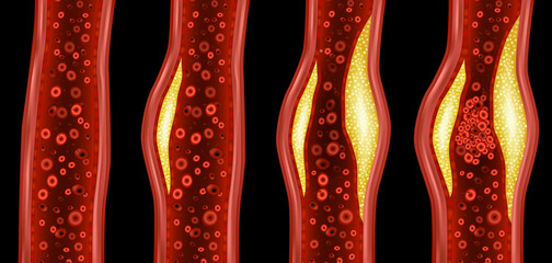Artery narrowed by plaque and Normal artery. Atherosclerotic plaque. Cholesterol plaque in artery  
