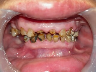 Obraz premium Closeup of severely damaged and decayed teeth