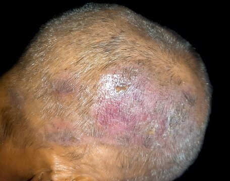 Tinea Capitis or Fungal Infection on the scalp