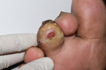 Diabetes foot ulcer of Asian patient.