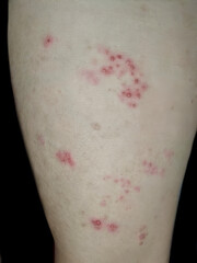 Multiple blisters on the thigh, indicating a skin irritation or infection