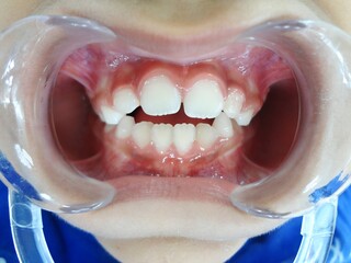 A close-up view of an open mouth showing teeth and gums, likely for dental examination.