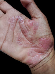 Dermatitis on the hand characterized by red, scaly and peeling skin.