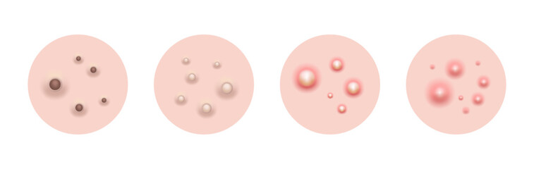 Acne skin pimple, vector illustration