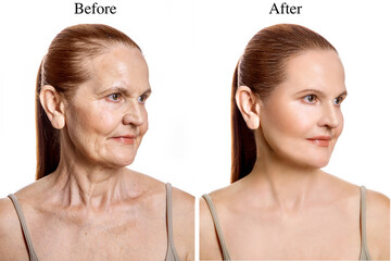 Rehabilitation of the skin and muscles of the face and neck in adulthood. Before and after revitonics, lifting and facebuilding