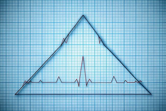 Anatomy of Einthoven ECG triangle with augmented unipolar limb lead
