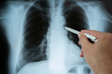 Doctor radiologically analyzing the chest with x-ray.Hand of a doctor analyzing and pointing with a pen to the affected area