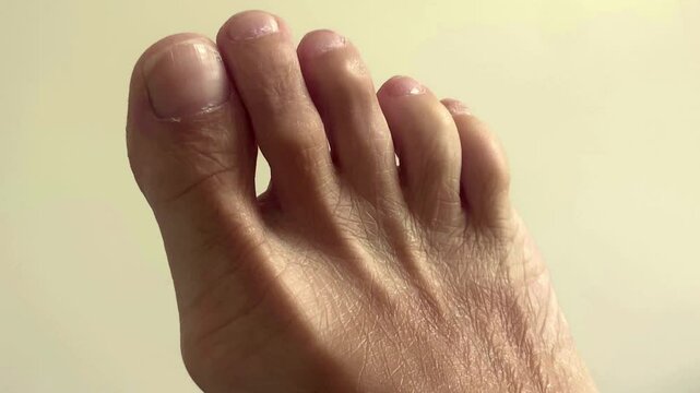 Valgus deformity of the first finger. Overall plan
