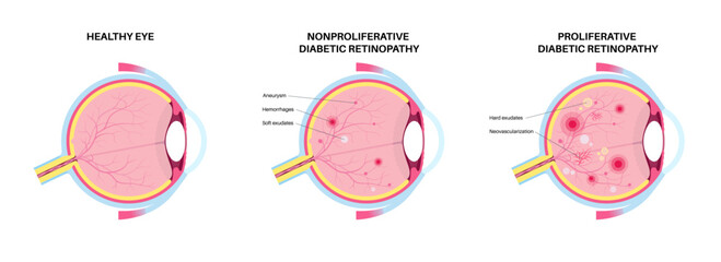 Diabetes related retinopathy