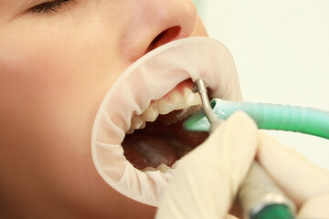 Woman patient during dental prophylaxis with powder blasting preventive treatment by the...