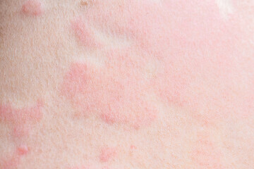 Skin allergy rash dermatitis texture close up