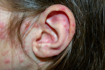 Natural vaccination. Contagious disease. Sick child with chickenpox. Varicella virus or Chickenpox...