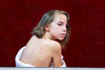 Natural vaccination. Contagious disease. Sick child with chickenpox. Varicella virus or Chickenpox...