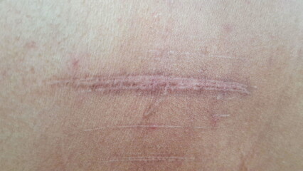 Accidents leave scars on the skin.
