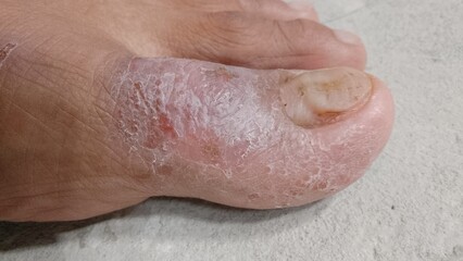 the skin of the big toe is cracked and watery. eczema disease