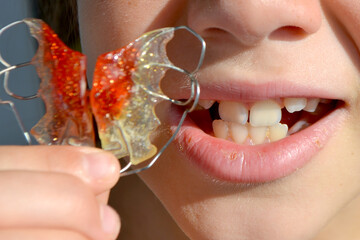 Dental braces. Teenager girl wearing orthodontic appliance dental treatment to improving bite gap....