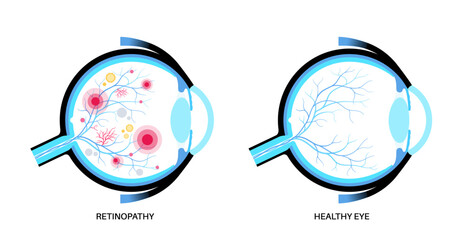 Diabetes related retinopathy