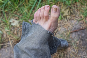 man leg with toes sticking out of hole blue ripped dirty jeans leg on street