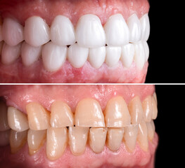 zirconium ceramic crowns and veneers