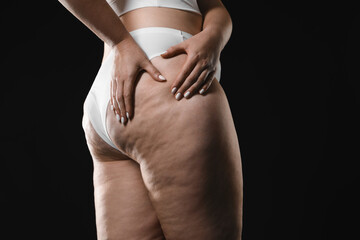 Woman with cellulite on black background, closeup. Space for text