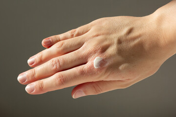 Close-up of a woman applying a topical treatment to eczema on her hands.
