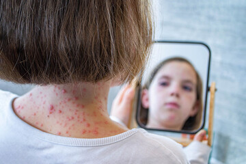 Natural vaccination. Contagious disease. Sick child with chickenpox. Varicella virus or Chickenpox...