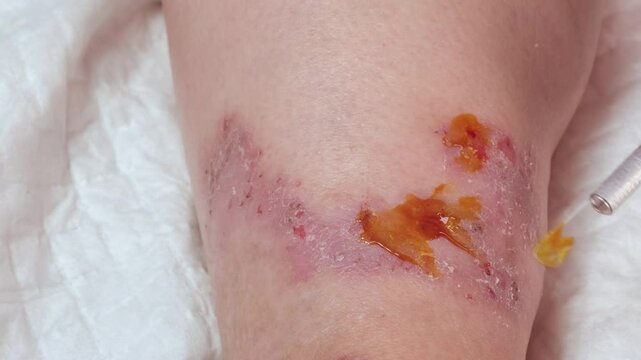 doctor, nurse heals with medicine wounds, venous ulcers on female leg, diabetes mellitus, varicose veins, healing ulcers, eliminating inflammatory process, sanitation pathogenic microflora