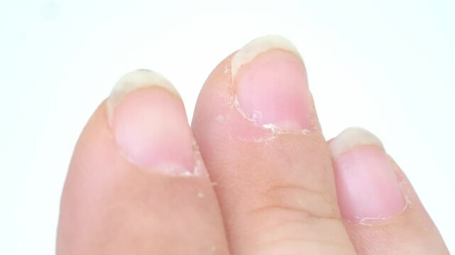 Compulsive nail and cuticle biting, Stress relief or self-harm, obsessive-compulsive disorder, mental health