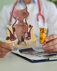 Doctor holds model of unhealthy lower rectum with inflamed vascular structures and medication pill