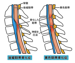 後縦靭帯骨化症と黄色靭帯骨化症（文字あり）