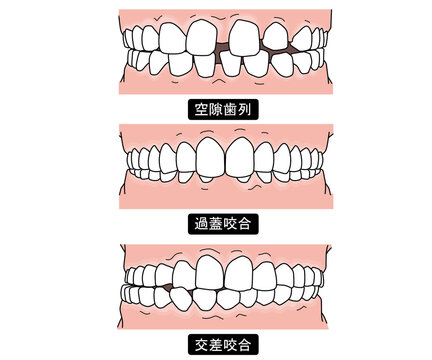 歯列矯正が必要な歯並びPart1