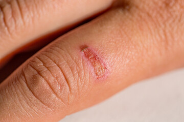Fototapeta premium Close up image of severe burn on a womans finger from cooking.