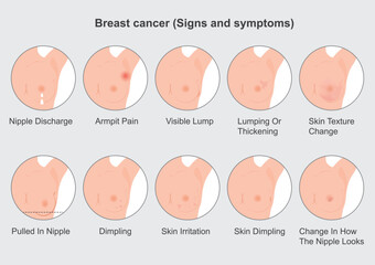 Breast cancer caught early is the most treatable kind of breast cancer.