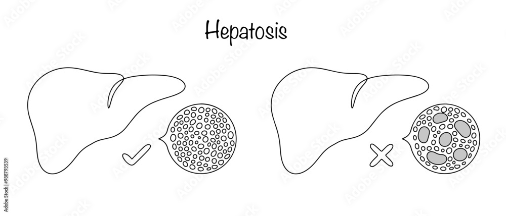 Wall mural hepatosis