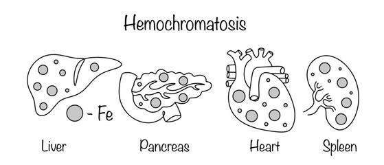 Hemochromatosis