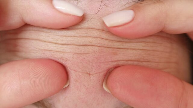 Female hands touching and squeezing her forehead wrinkles lines close up. Aging problems concept