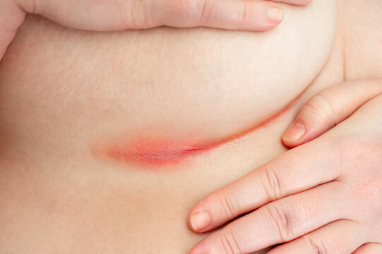 A patient with intertrigo shows an erythematous rash in the skin folds. Skin irritation under breast, with redness. Corynebacterium minutissimum