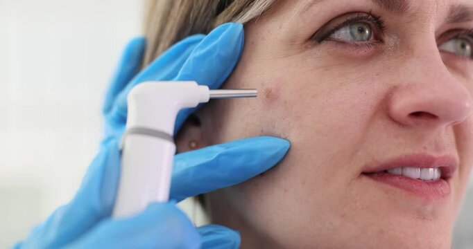 Dermatologist removes birthmark from blonde woman cheekbone using laser device. Doctor conducts precise cosmetic procedure for skin treatment