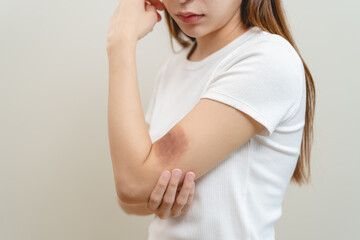 Close up of stain bruise wound on arm, contusion asian young woman, girl an accident fell down...