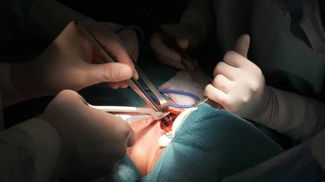 Crop surgeons performing operation on patient in dark room, thyroid gland removal surgery