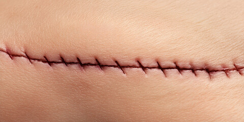 Close-up of a surgical scar with stitches, detailed view of sutured wound, macro of healing skin with stitches, post-surgery scar close-up, realistic depiction of stitched wound, medical image of scar