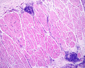 Smooth muscle. Inflammatory infiltrate