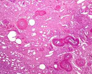 Human kidney. Nephrosclerosis