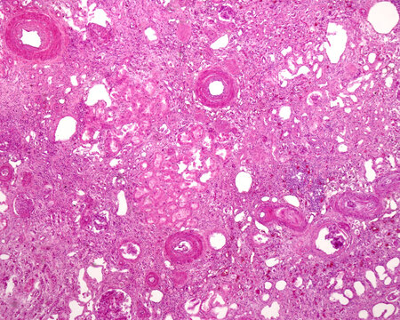 Human kidney. Nephrosclerosis