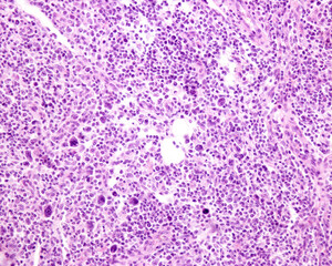 Lymph node. Hodgkin lymphoma