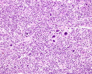Lymph node. Hodgkin lymphomah