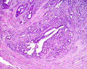 Gastric carcinoma